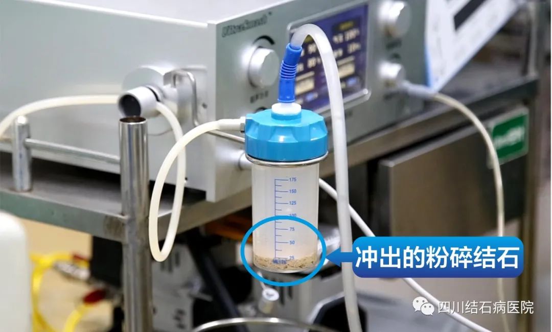 膀胱结石最大的有多大,罕见膀胱结石