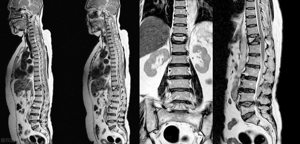 腰椎l3l4l5轻度膨出会压迫神经吗,腰椎l5s1轻度膨出适合什么锻炼