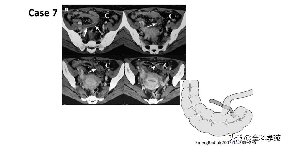 阑尾炎的讲解,关于阑尾炎的讨论总结