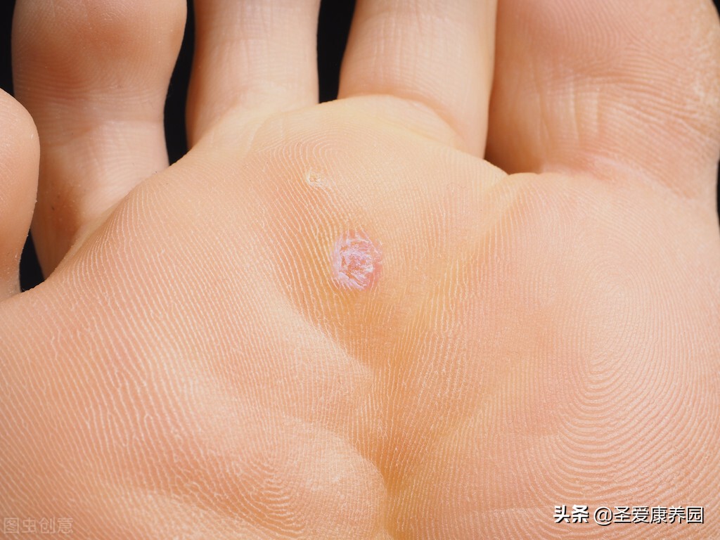 身上长了个小肉疙瘩怎么注意,身上长了很多小肉疙瘩是怎么了