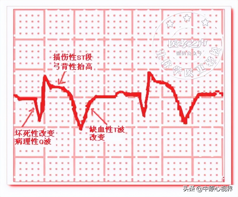 护考几种常见的心电图,常见的心电图图形分析