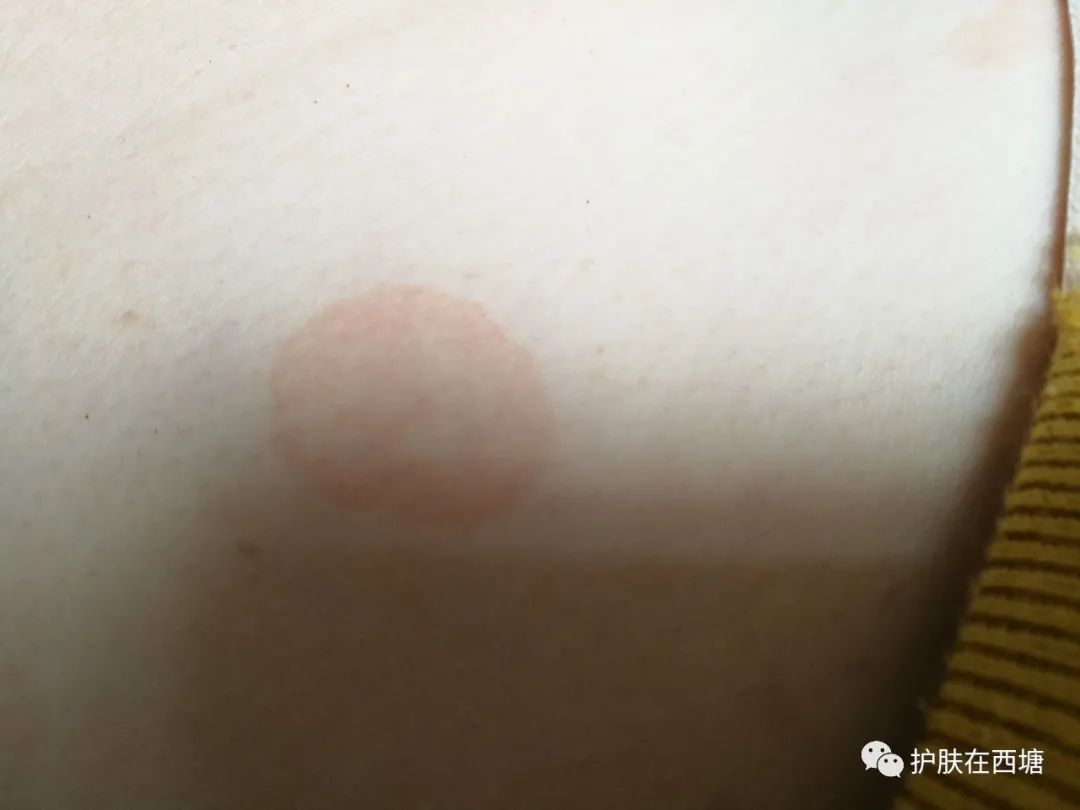 汗斑跟花斑癣,汗斑和花斑糠疹区别