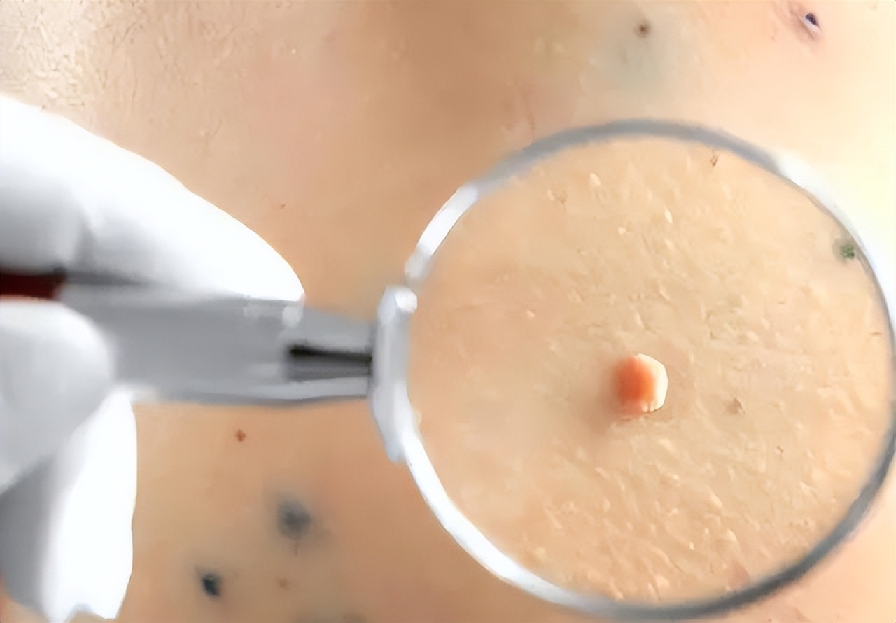 皮肤下长了小肉球如何去除,皮肤长小肉球用什么药膏