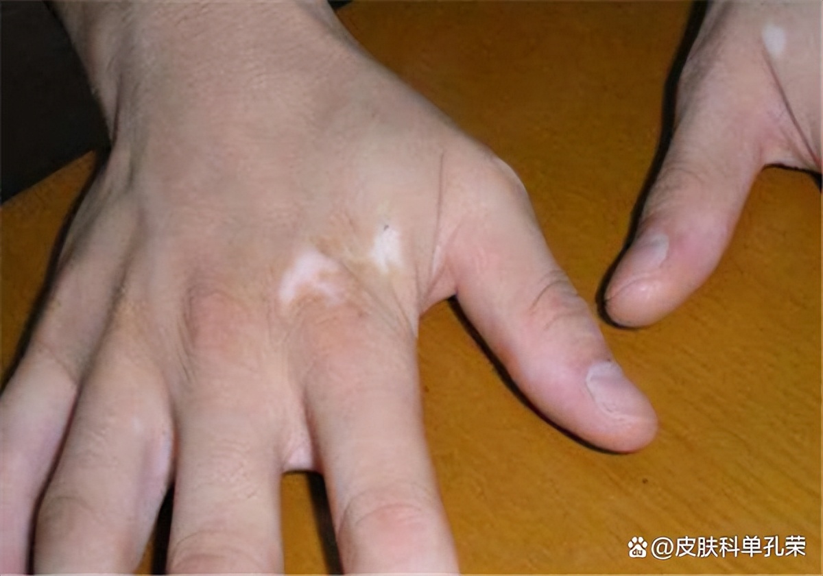 白斑发红发痒是什么原因,白斑痒了是意味着白斑发展了吗