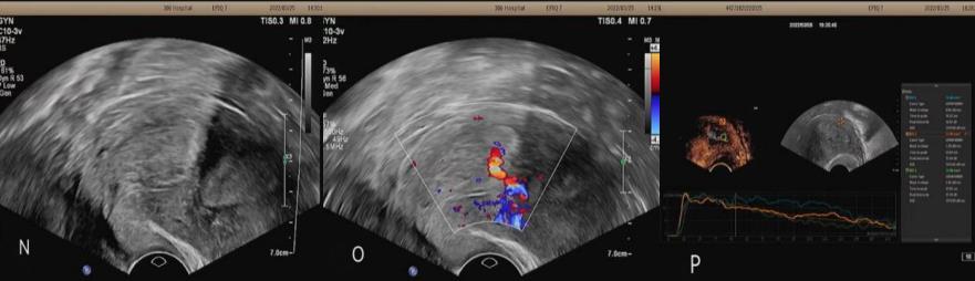 超声静脉造影剂注射操作视频,超声静脉自显影