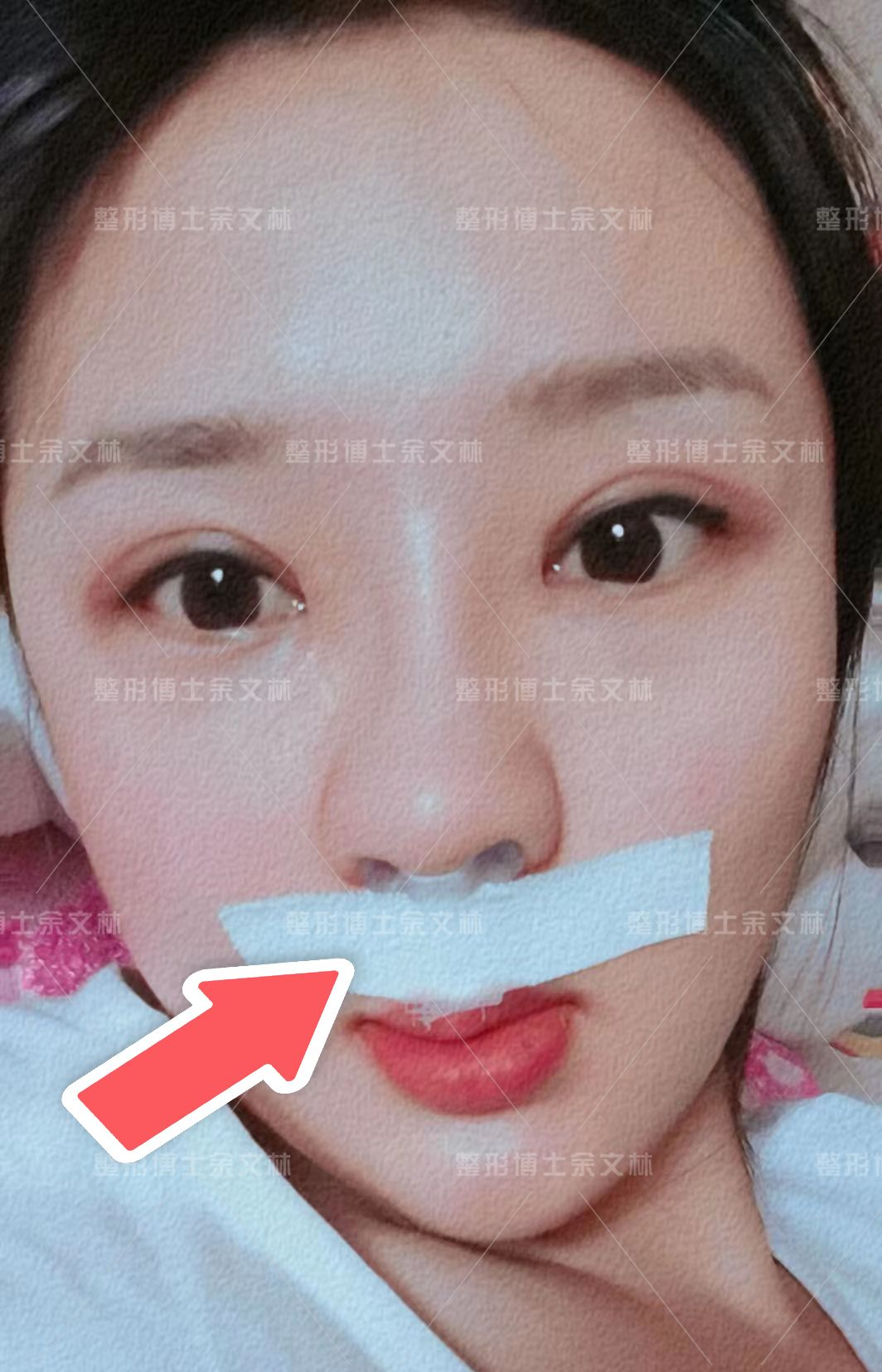 唇裂怎么消除疤痕,唇裂术后怎么预防增生