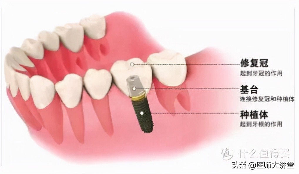 医院种植牙掉了如何赔偿,种植牙齿失败后可以要求赔偿吗