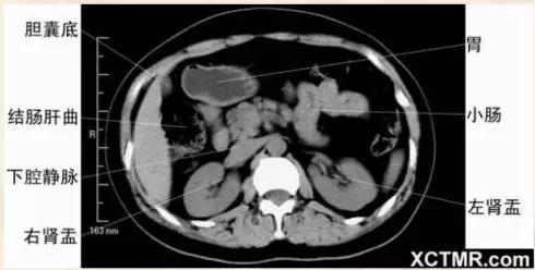胸腹部盆腔ct主要检查什么,女性盆腔ct断层解剖结构图