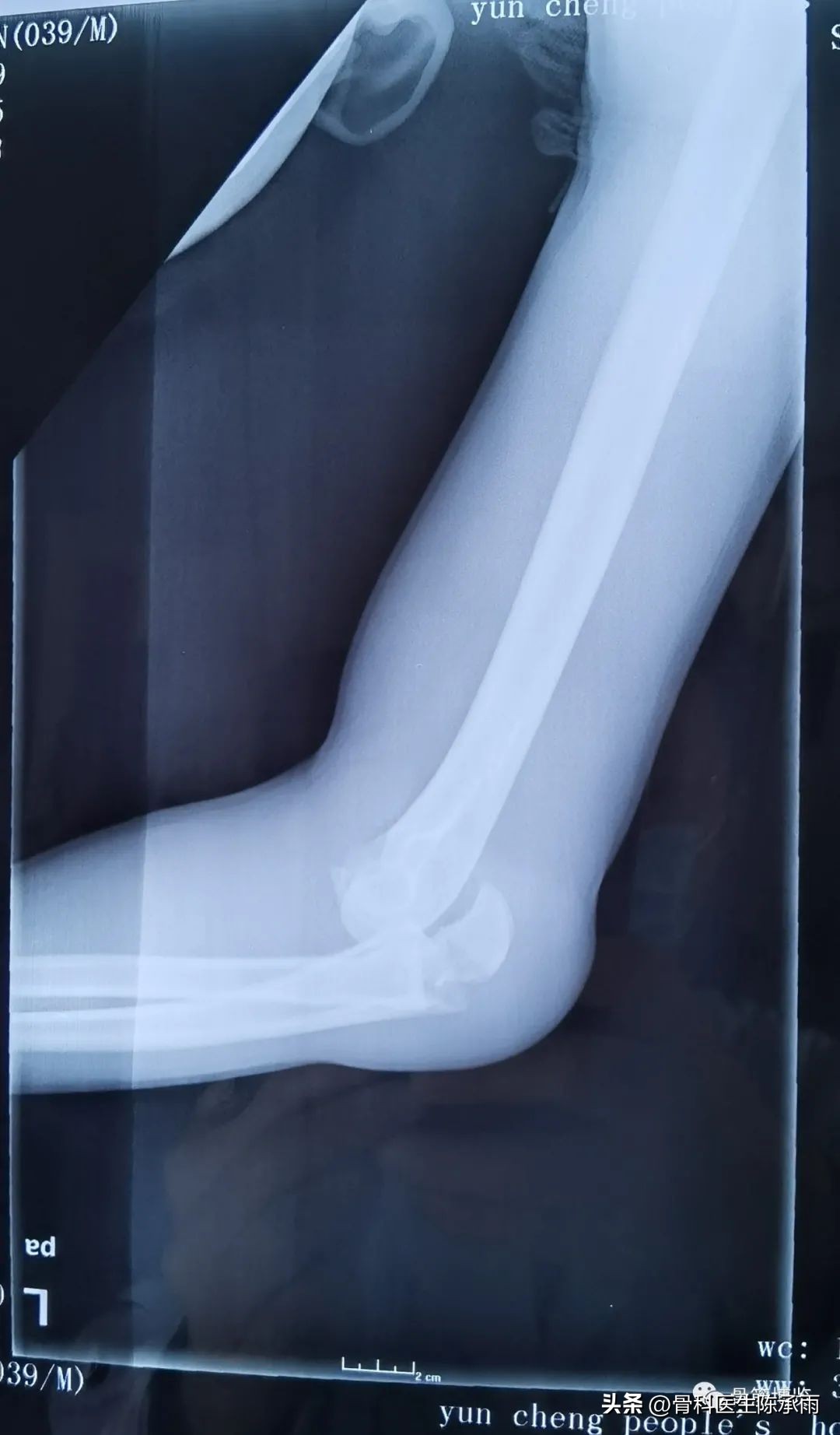 肘关节恐怖三联征最新治疗方法,肘关节恐怖三联征最佳治疗方法