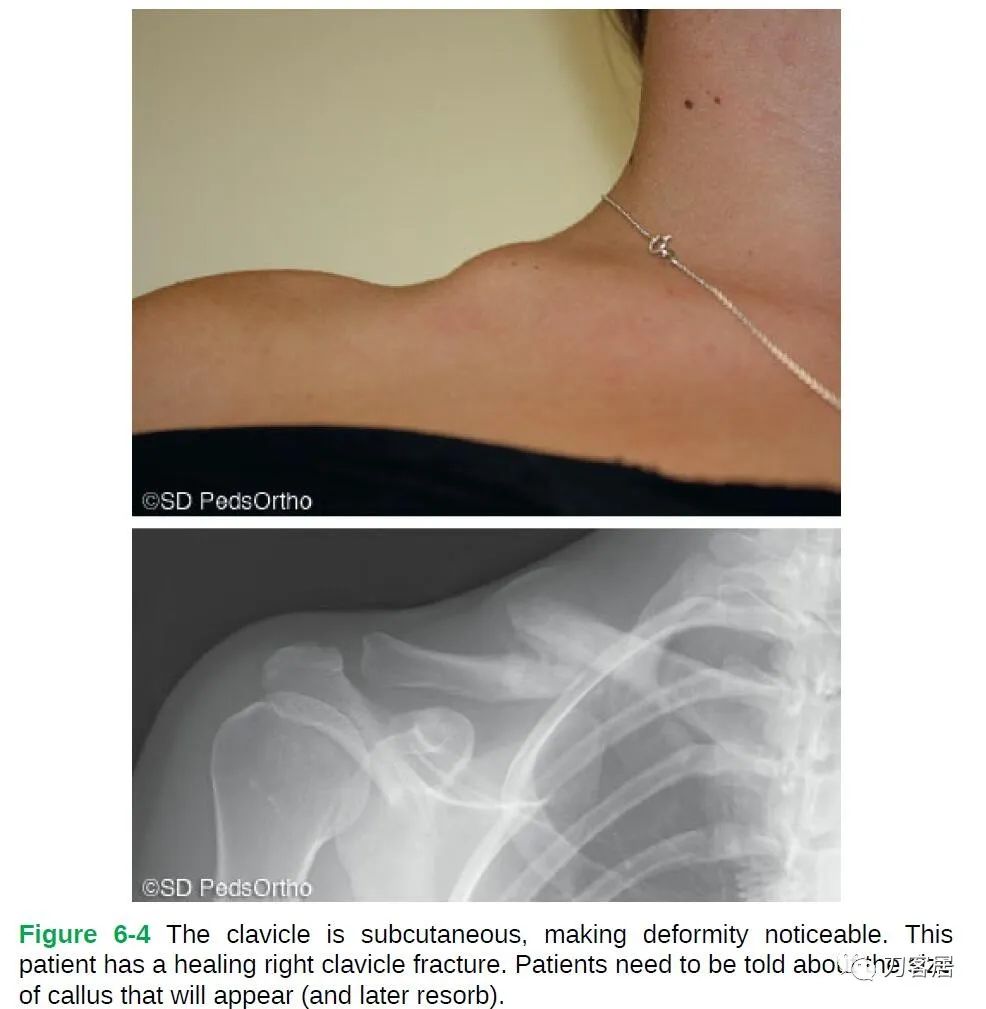 儿童锁骨骨折保守治疗的弊端,锁骨粉碎骨折错位不处理会愈合吗