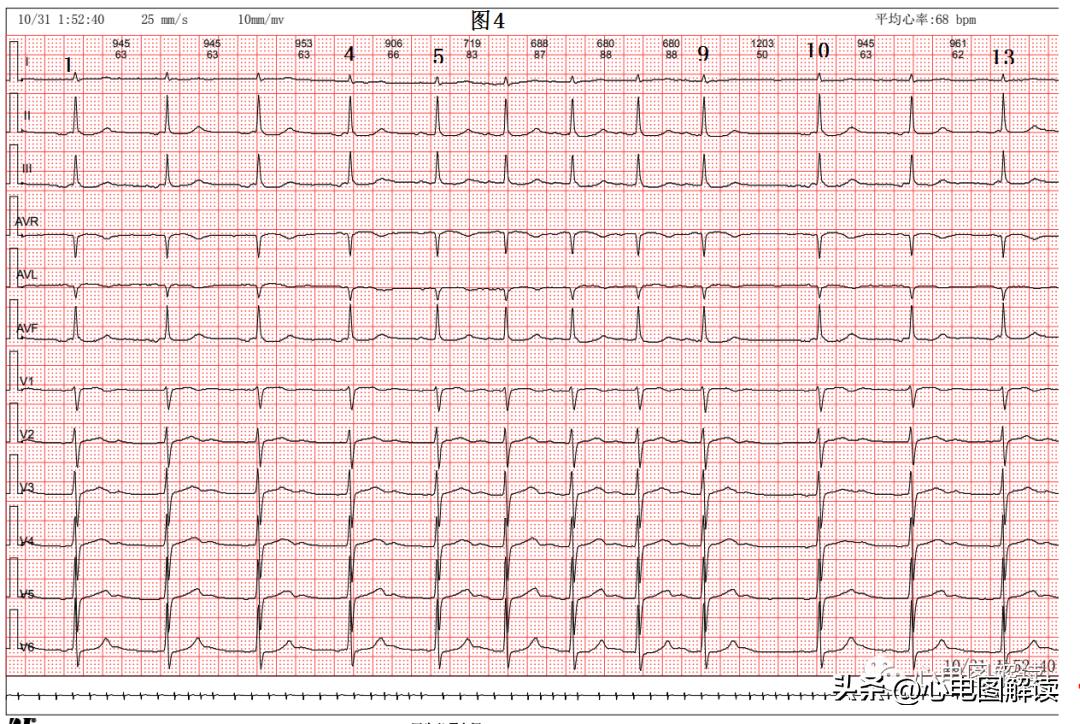 窦房结至心房之间的游走心律、房性心律的诱发原因之一