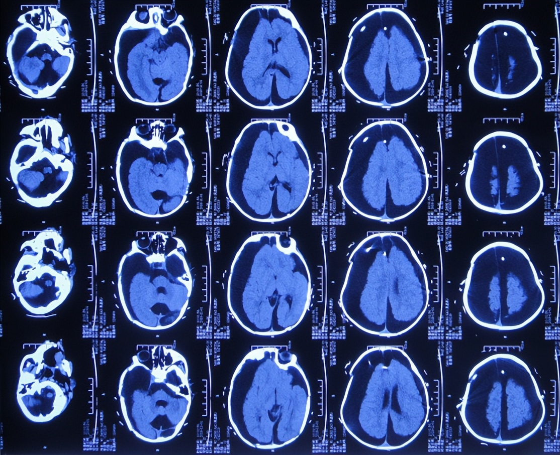 蛛网膜囊肿合并脑积水腹腔分流术,治疗蛛网膜囊肿引起脑积水严重吗