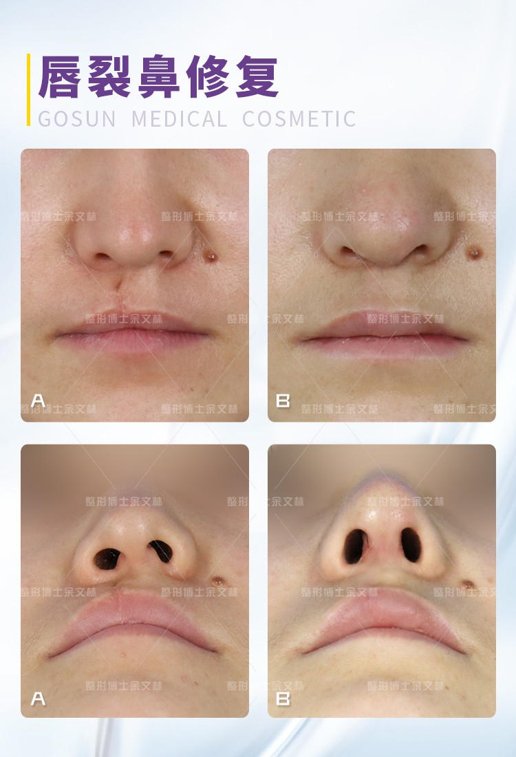 唇裂继发畸形修复全国哪家最好,宝宝唇裂畸形的手术修复费用