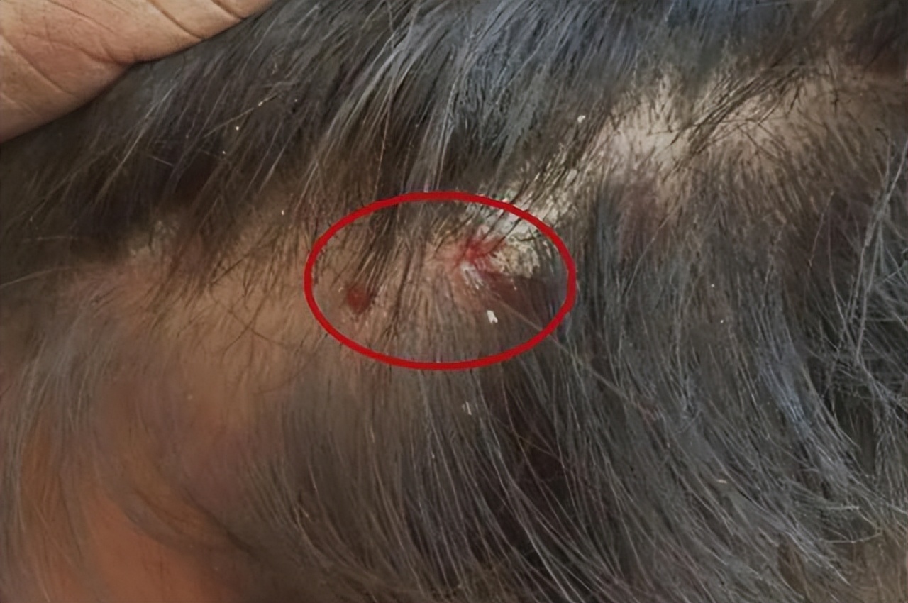 头皮经常起疙瘩有脓包是什么原因,头皮总是长疙瘩或脓包是什么原因