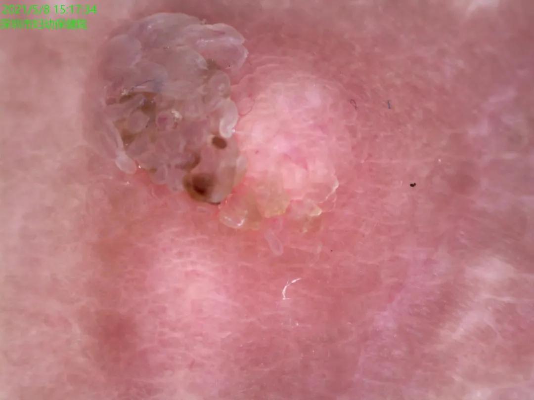 怀孕后脖子、身上长满了一粒粒小疙瘩，会传染吗？