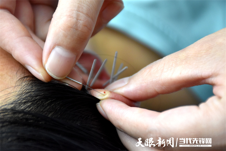 【健康连线】失眠、睡不着？道真自治县中医医院新技术助你安然入睡