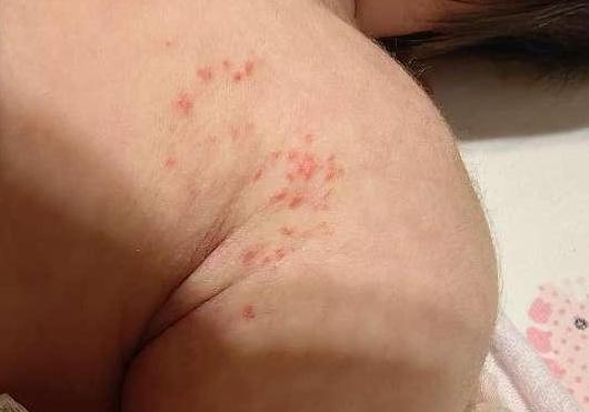 婴儿身上出现像蚊子咬的红色斑块,宝宝身上有像血管瘤一样的小红点