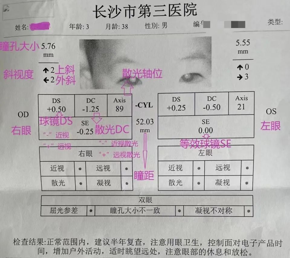 医生解读视力检查表上的常见指标,儿童视力报告单数值怎么看