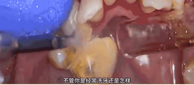 口腔溃疡跟牙龈炎挂口腔哪个科室,扁桃体和牙龈挂号看哪科