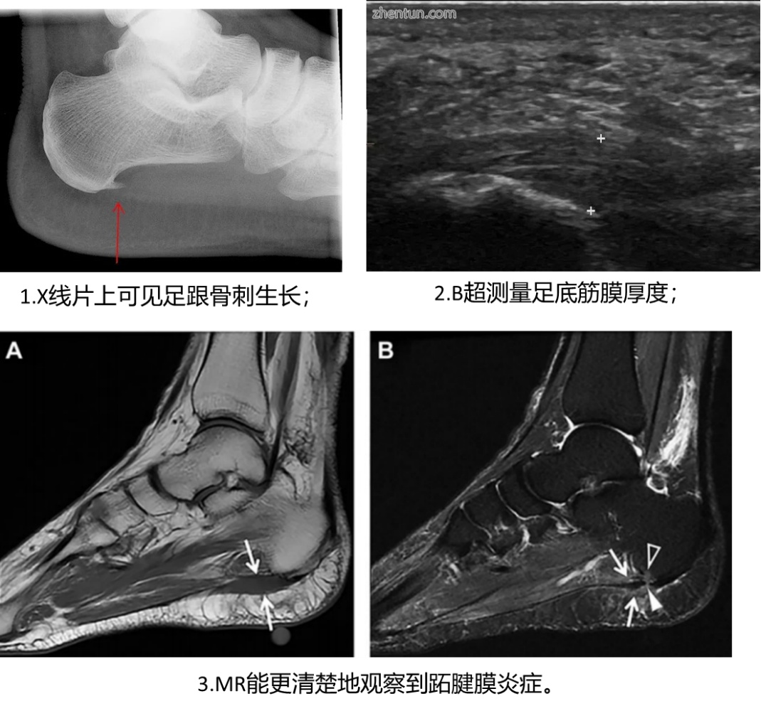 老人脚跟痛怎么治疗最好,后脚跟痛是怎么回事怎么样治疗