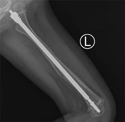 让“瓷娃娃”不再脆弱，青岛妇儿医院完成省内首例“脆骨症”患儿可延长髓内针内固定术