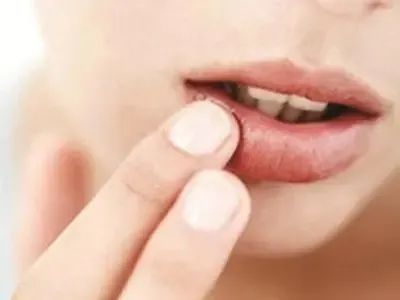 总是嘴角烂口腔溃疡是什么原因,嘴角老烂口腔溃疡吃什么水果