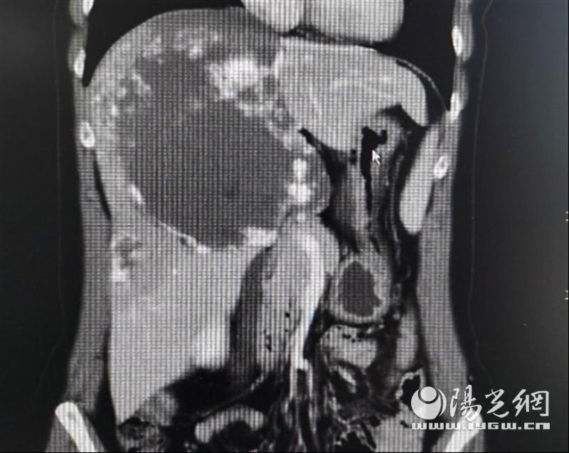 交大一附院肿瘤手术,交大一附院肝血管瘤腹腔镜手术
