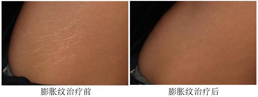 光子嫩肤济南市中心医院,济南光子嫩肤哪家医院最好