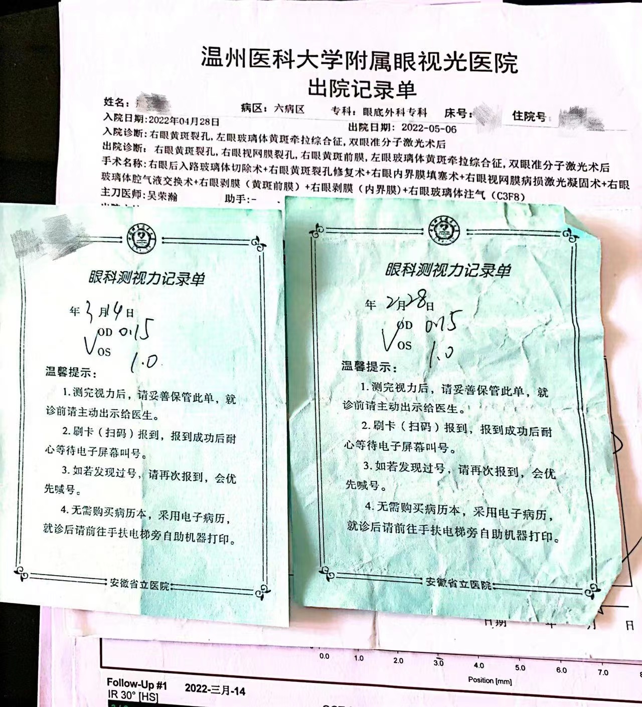 黄斑裂孔手术恢复视力几率有多大,做黄斑裂孔手术是否能引起失明