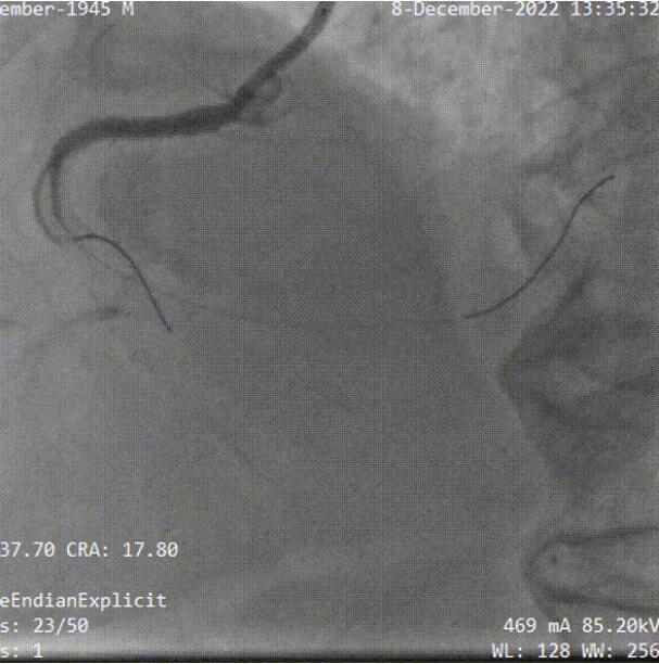 3DF打印助力温州医科大温州医科大学附属第一医院周浩团队完成一例复杂高危的冠脉CTO手术