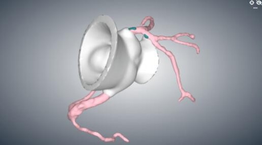 3DF打印助力温州医科大温州医科大学附属第一医院周浩团队完成一例复杂高危的冠脉CTO手术