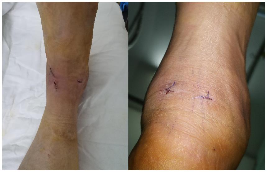 扭伤脚踝五十多天了走路就肿,踝关节扭伤半年后突然疼痛