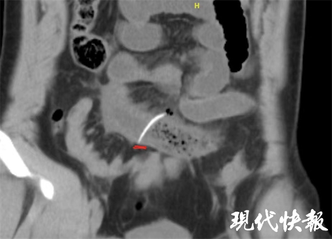 小伙吃烤鱼不料引起肠壁穿孔,小伙吃了顿酸菜鱼食管穿孔
