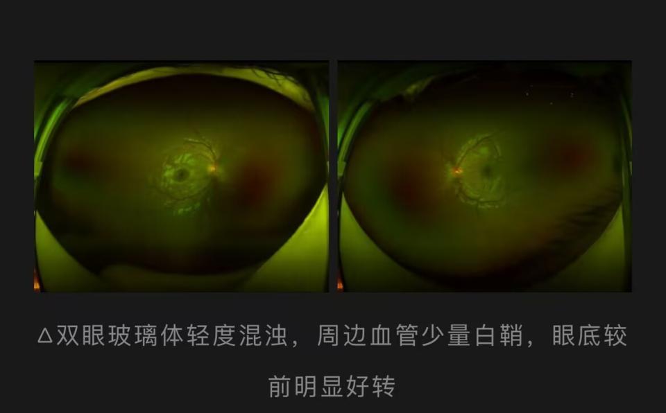 小孩眼睛一直发红不痛视力下降,七岁小孩眼睛发红反反复复怎么办